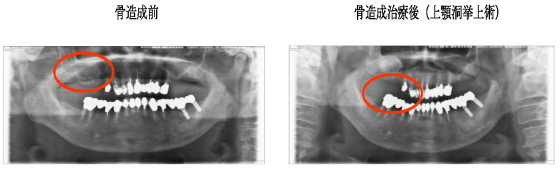 骨造成