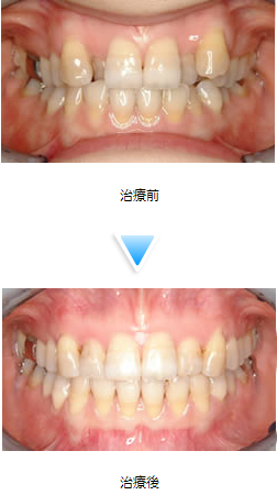 叢生（乱杭歯）