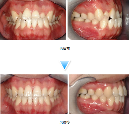 反対咬合（受け口）