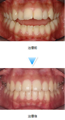 上顎前突（出っ歯）