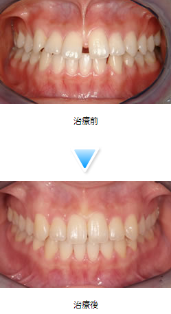 上顎前突（出っ歯）