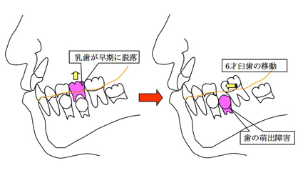 歯の萌出障害