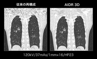 胸部CTサンプル